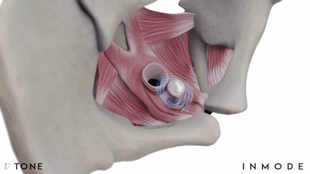 Beneficios de la electroestimulación para el suelo pélvico